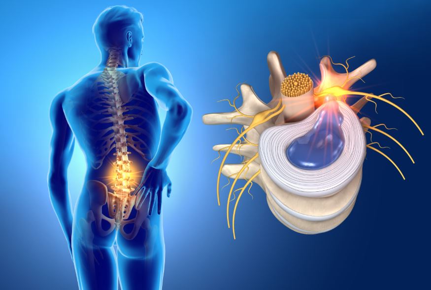 Sciatica & Slipped Disc